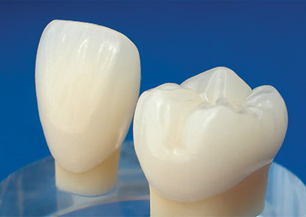 オールセラミック