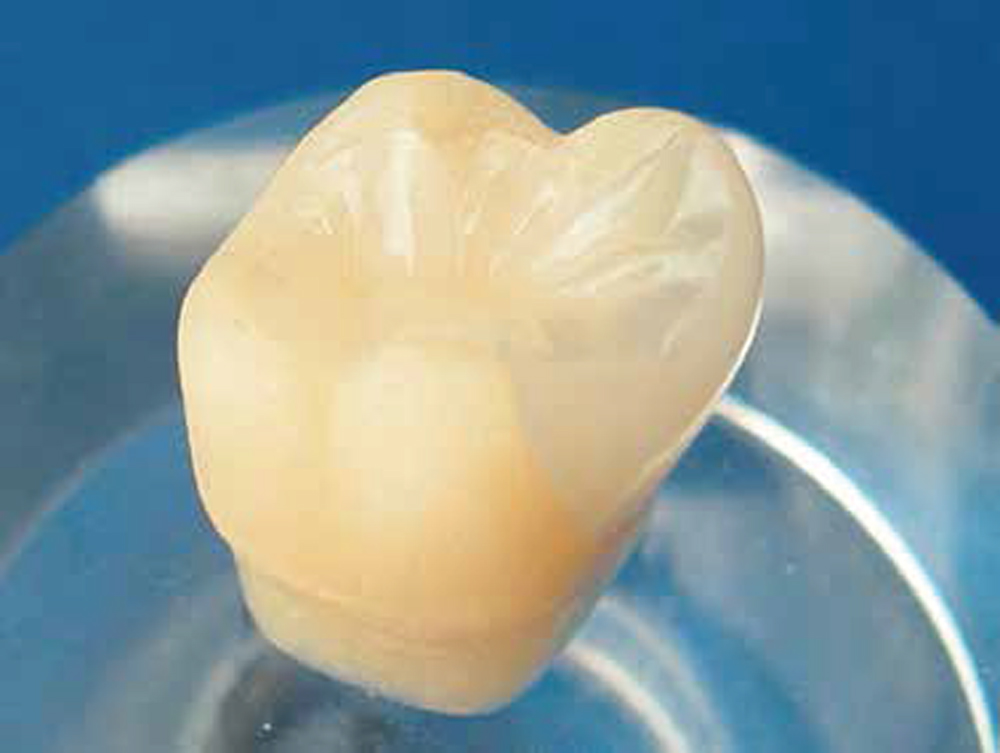 ジルコニアインレー